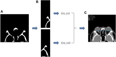 Automatic measurement of exophthalmos based orbital CT images using deep learning